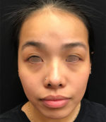 Around The Mouth Fillers