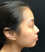 Around The Mouth Fillers