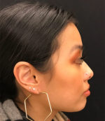 Around The Mouth Fillers