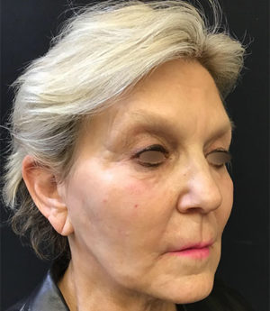 Around The Mouth Fillers