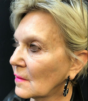 Around The Mouth Fillers