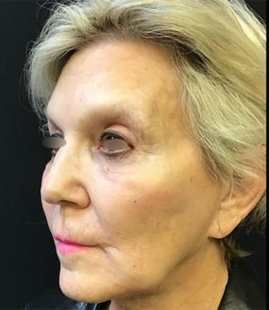 Around The Mouth Fillers