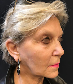 Around The Mouth Fillers