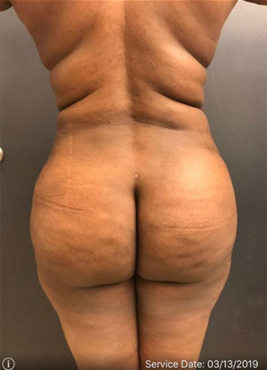 Brazilian Butt Lift