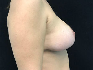 Breast Reconstruction