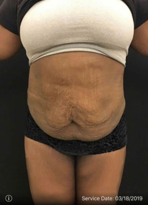 Liposuction