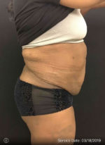 Liposuction