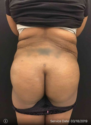 Liposuction