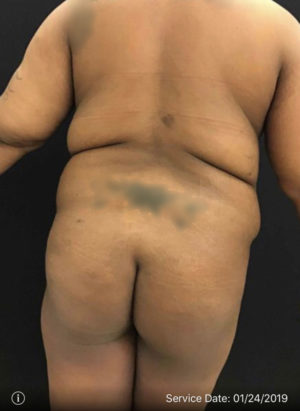 Liposuction