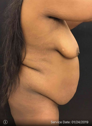 Liposuction