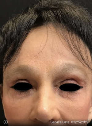 Around The Eye Fillers