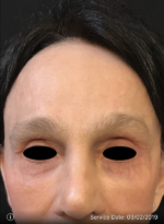 Around The Eye Fillers