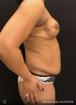 Breast Reconstruction