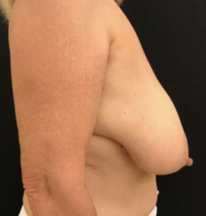 Breast Reduction