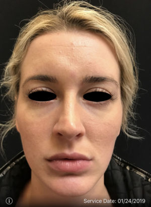 Around The Eye Fillers