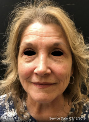 Botox Cosmetic and Dysport