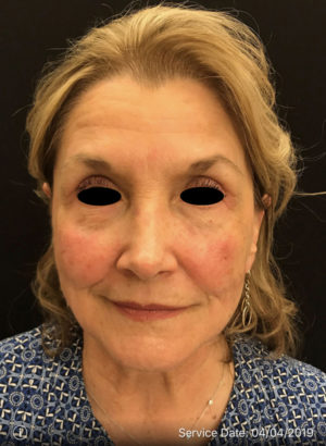 Botox Cosmetic and Dysport