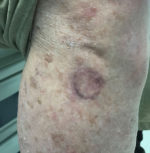 Squamous Cell Carcinoma