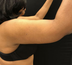 BodyTite