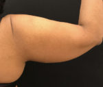 BodyTite