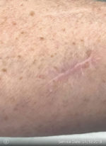 Squamous Cell Carcinoma