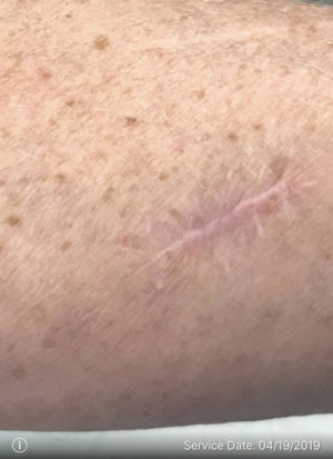 Squamous Cell Carcinoma