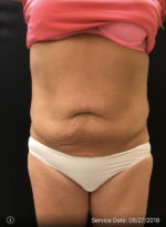 BodyTite