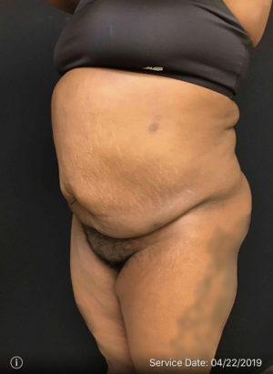 Liposuction