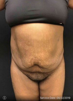 Liposuction