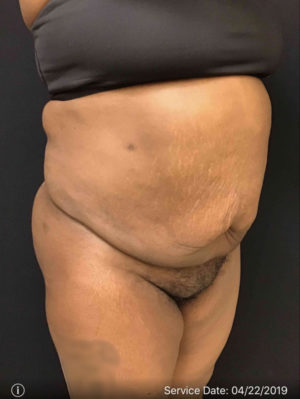 Liposuction