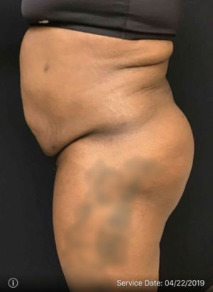 Liposuction