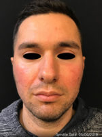 Around The Eye Fillers