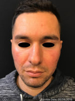 Around The Eye Fillers