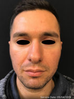 Around The Eye Fillers