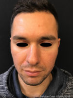 Around The Eye Fillers