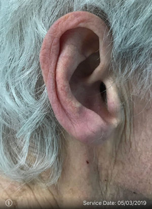 Ear Surgery