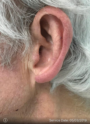Ear Surgery