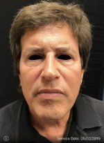 Around The Eye Fillers