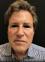 Around The Eye Fillers