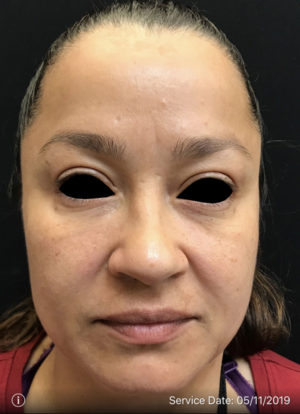 Around The Eye Fillers