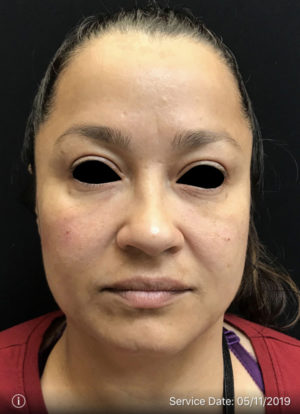 Around The Eye Fillers