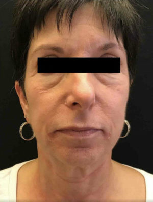 Exilis