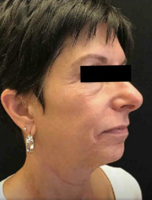 Exilis