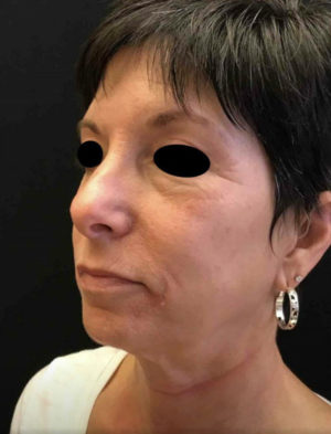 Exilis