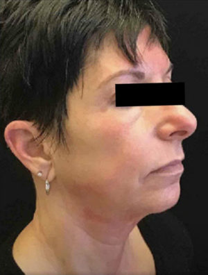 Exilis