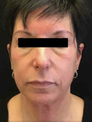 Exilis