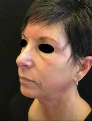 Exilis