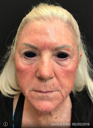 Botox Cosmetic and Dysport