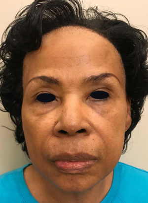 Botox Cosmetic and Dysport