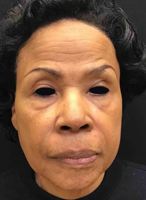 Botox Cosmetic and Dysport